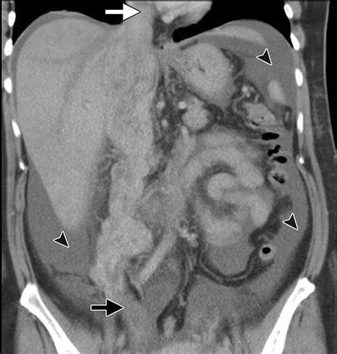 Leiomyosarcoma Of The Inferior Vena Cava Airp Best Cases In Radiologic