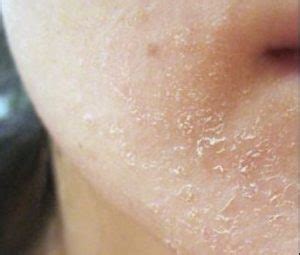 Dry Skin On Face Causes Treatment And Home Remedies