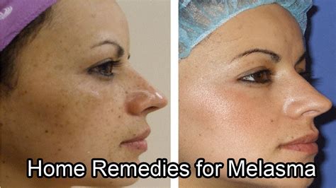 Home Remedies For Melasma How To Get Rid Of Melasma At Home With