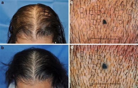 Male And Female Pattern Hair Loss Before And After Lasercomb Treatment Download Scientific
