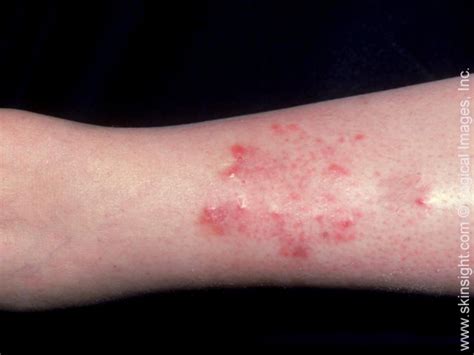 Stasis Dermatitis National Eczema Association
