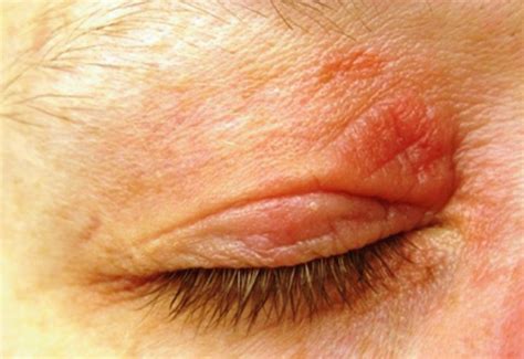 Eczema On Eyelids Causes Symptoms And Treatments Disfreeskin