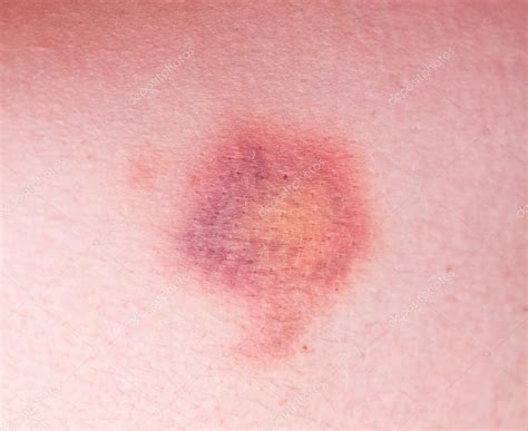 Closeup On A Bruise On Wounded Stock Photo By ©8r1n31k2010 120906898