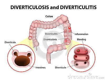 Diverticulosis And Diverticulitis Cartoon Vector Cartoondealer Com