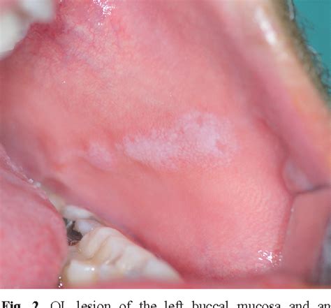 Figure 2 From Oral Leukoplakia Associated With Amalgam Restorations