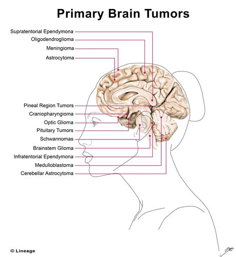 Primary Brain Tumors Usmle Strike