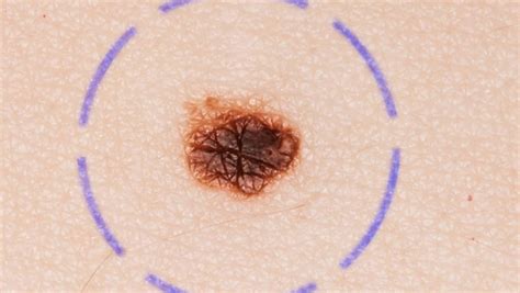 Skin Cancer Check Number Of Moles On Your Right Arm An Indicator Of Risk Experts Say Herald Sun