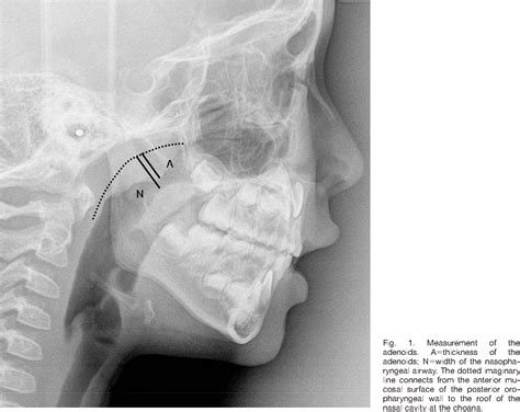 Figure 1 From Regrowth Of The Adenoids After Coblation Adenoidectomy