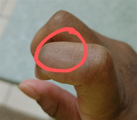 Herpes On Finger
