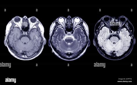 Cerebral Hemorrhage Brain Scan Banque De Photographies Et Dimages à Haute Résolution Page 2