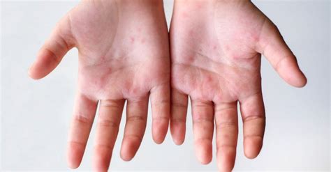 Blister Itchy Rash On Hands Dyshidrosis Symptoms And Causes