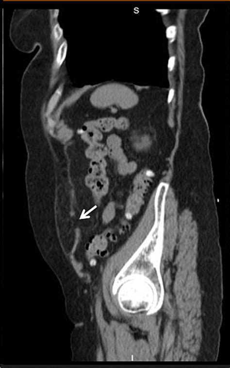 Ct Scan Of A 69 Year Old Female With Spigelian Hernia Adipose Tissue