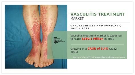 Vasculitis Treatment Market Size Share Statistics Report 2031