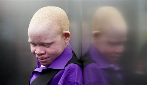 For Africas Hunted Albino Children New Limbs And New Hope