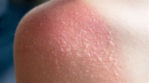 If You Get Sunburn Blisters Heres What You Should Do