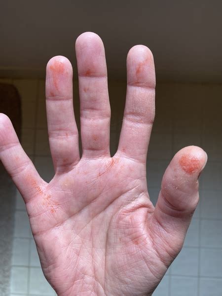 What Are These Orange Stains That Have Appeared On My Hands Overnight