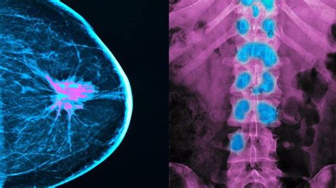 Signs Of Metastatic Breast Cancer