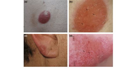 A Clinical Picture Of A Primary Cutaneous Follicle Center Lymphoma