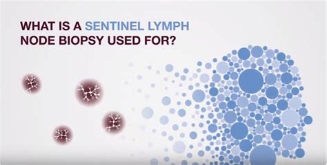The Importance Of Sentinel Lymph Node Biopsies In The Diagnosis Of Head