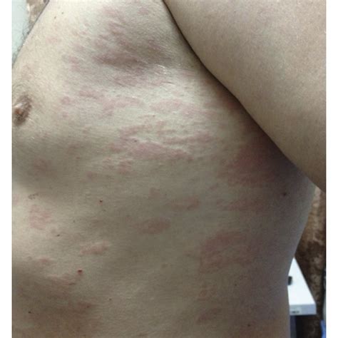 Urticarial Rash On The Back A And Side Of The Torso B Download
