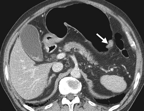 Evaluation Of Early Gastric Cancer At Multidetector Ct With Multiplanar