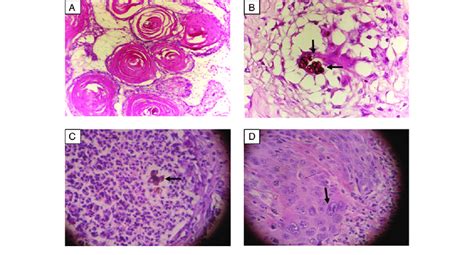 A Well Differentiated Squamous Cell Carcinoma B Histological