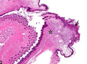 Penis Prepuce Inflammation Nonneoplastic Lesion Atlas