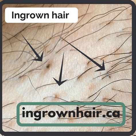 What Causes Ingrown Hairs And How To Treat And Prevent Them Ingrown