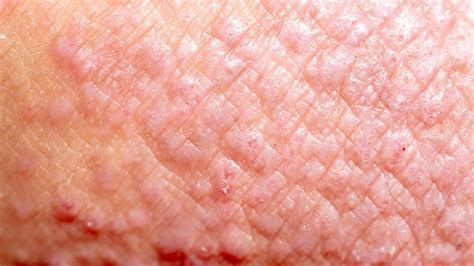 Dermatitis Pictures