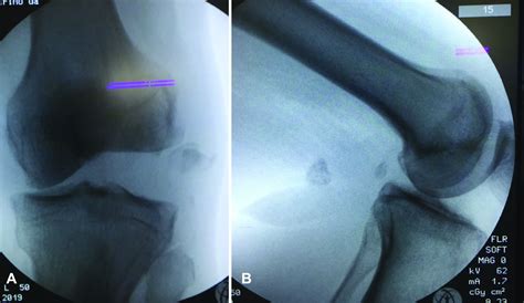 Scielo Brasil Osteochondral Segond Fracture Associated With Fibular