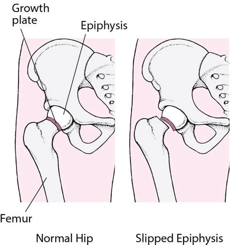 Figure Slipped Capital Femoral Epiphysis Msd Manual Consumer Version