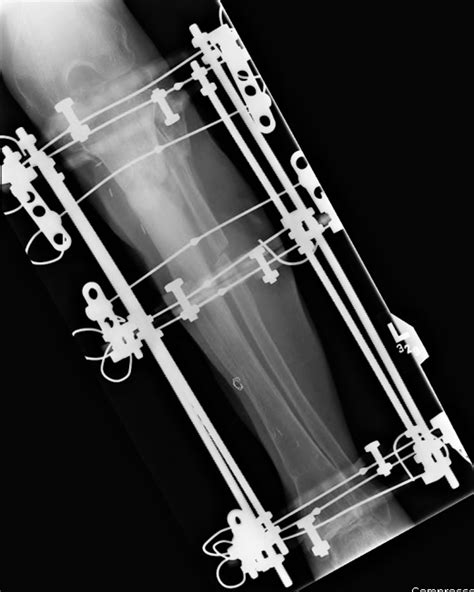 Fracture Fixation A Gallery