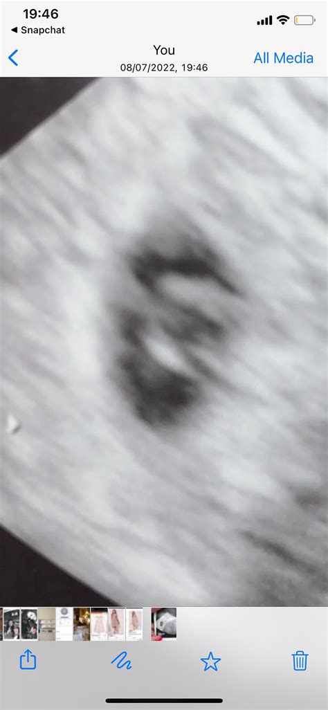 Second Scan After Miscarriage Babycenter