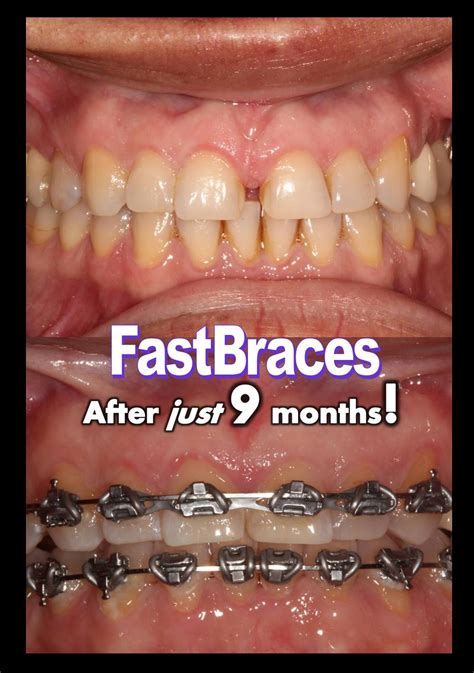1 doctor answer • 2 doctors weighed in. FastBraces | Sacramento Dentist