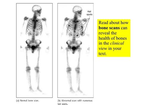 The rib cage contains synovial joints, a joint surrounded by a membrane containing a protective fluid. Can A Bone Scan Show Cancer - CancerWalls