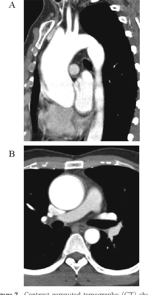 Figure 2 From A Case Of Surgery For Unicuspid Aortic Valve With Annulo