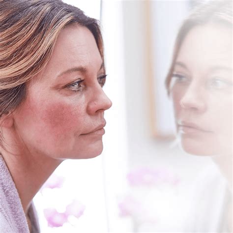 Rosacea Facial Redness That Wont Go Away Heres A Treatment That Can