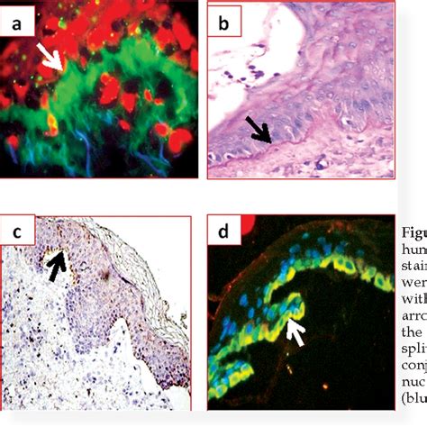 Figure 1 From Autoimmune Basement Membrane And Subepidermal Blistering