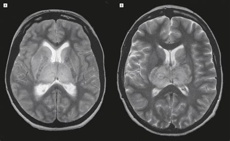 Resolution Of Bilateral Thalamic Lesions Due To Deep Cerebral Venous