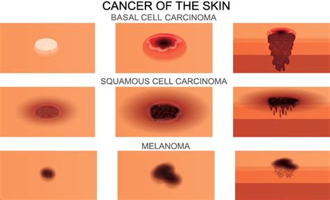 Basal Cell Carcinoma Aapc Knowledge Center
