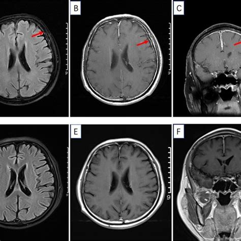 Ac Brain Mri Findings Before Therapy A Axial Mri Brain T2 Flair