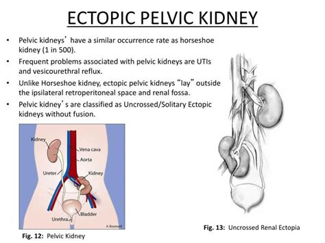 Ppt Crossed Fused Renal Ectopia Imaged With Tc99m Mag₃ Powerpoint