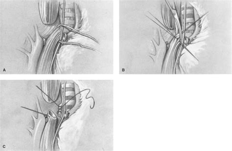 Surgical Repair Of Tracheoesophageal Fistula And Esophageal Atresia