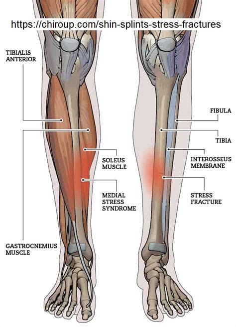 Fix Your Shin Splints Medial Tibial Stress Syndrome By Seth Donelson