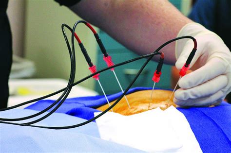 Radiofrequency Ablation Pros And Cons Vinmec