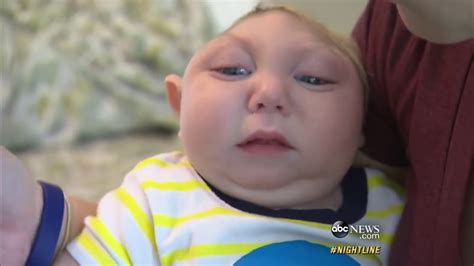 Miracle Baby Born Without Most Of His Brain Defying Odds ABC News YouTube