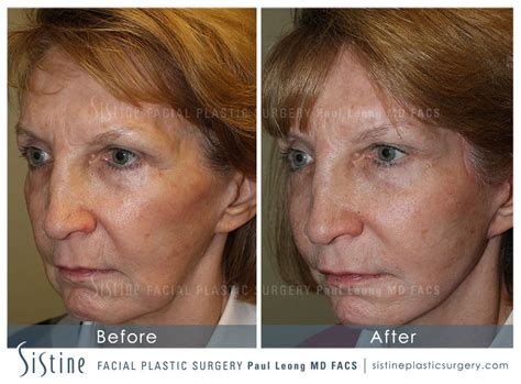 Sculptra Before And After 01 Sistine Facial Plastic Surgery
