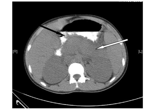 Non Contrast Computed Tomography Ct Scan Of The Abdomen Showing A