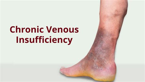 Chronic Venous Insufficiency Treatment Guidelines Dr Abhilash