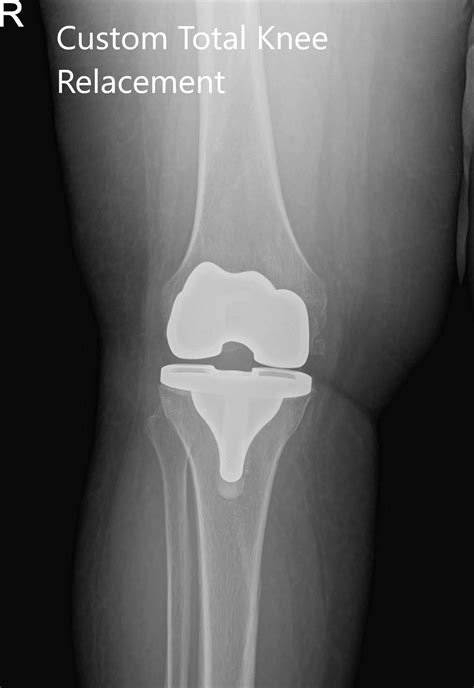 Case Study Right Total Knee Arthroplasty In 62 Yr Old Male